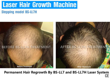 Laserowe urządzenie do odrastania włosów diod 650nm / 670nm do leczenia wypadania włosów