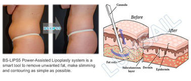 Liposukcja próżniowa wspomagana mechanicznie Maszyna kawitacyjna do ud / ramion / pleców