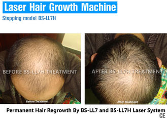 Wysokiej klasy terapia światłem lasera na wypadanie włosów, laserowe leczenie wzrostu włosów